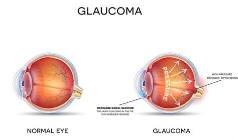 Glaucoma Prevention - Optometrist | Richardson Eye Associates