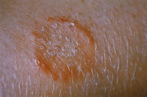 Ringworm Hair Loss: Signs, Causes & Treatments | Longevita