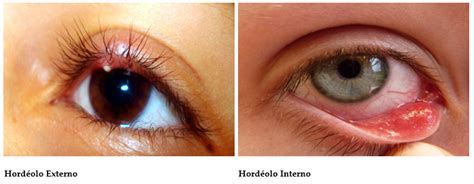 Hordéolo E Calázio