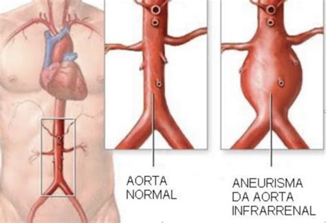 O Que É Aneurisma Na Aorta - Aneurisma da Aorta Abdominal (AAA) – SBACVSP