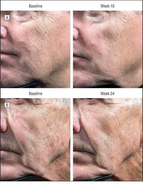 Pdf Topical Fluorouracil For Actinic Keratoses And Photoaging A