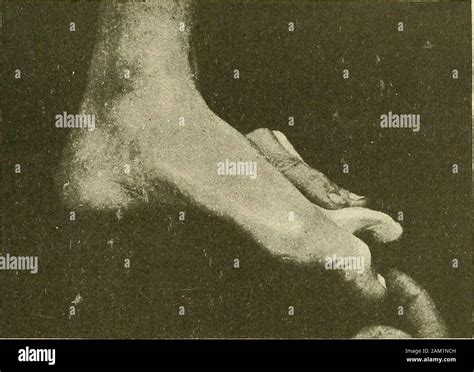 Shrapnel wound hi-res stock photography and images - Alamy