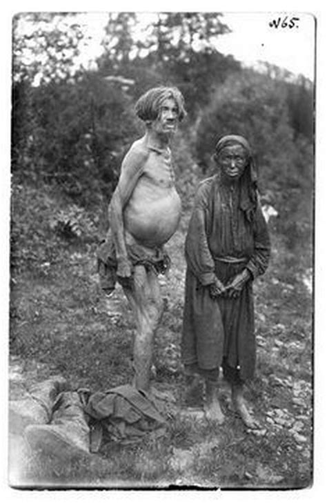 Шорцы-старик и старуха. Результаты шорского питания. Болезненное ...