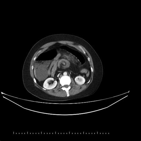 Axial Contrast Enhanced Ct Scan Image Showing The Whirlpool Sign Arrow