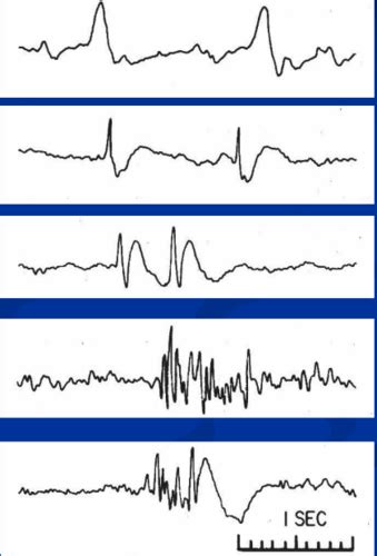 EEG Optional Flashcards Quizlet