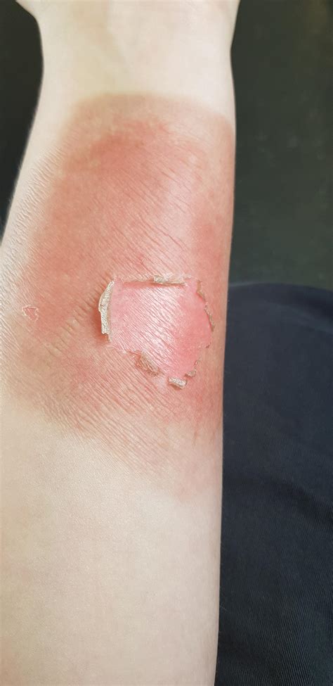 White wet second degree burn - tooldolf