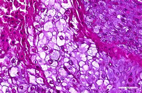 Solitary Oral Epidermolytic Acanthoma Case Report Of A Rarely