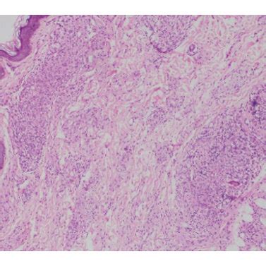 A Histopathological Examination Showing Dermal Granuloma With