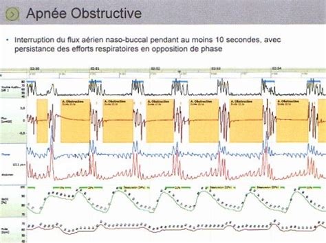 Le syndrome d apnées hypopnées obstructives du sommeil SAHOS