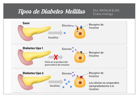 Tipos De Diabetes Cu Les Son Los S Ntomas Signos Y Tratamientos Tvsana