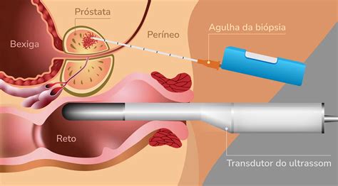 Como É Feita A Biópsia De Próstata