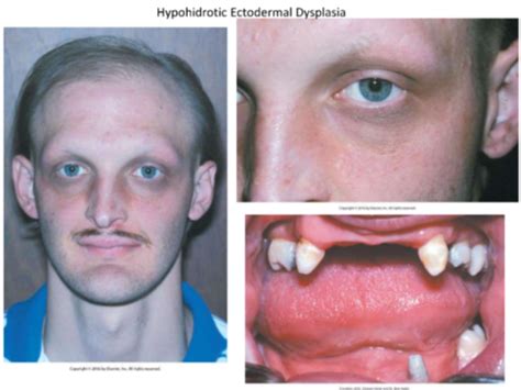 Ectodermal Dysplasia Teeth
