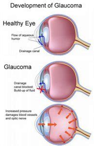 glaucoma knowledge sheet himachal eye hospital