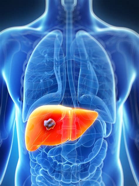 Liver Cancer Stock Illustration Illustration Of Graphic 13325167