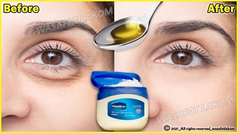 In Days Remove Under Eye Bags Completely Remove Dark Circle