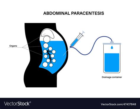 Abdominal Paracentesis Poster Royalty Free Vector Image