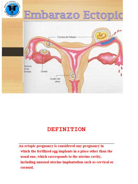 Pregnancy Ectopic Ppt In Pdf Pdf Gynaecology Women S Health