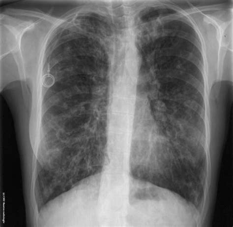 Dilatations Des Bronches
