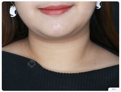 skin tags   treat   treatment