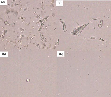 Calcium Phosphate Crystals In Urine Sediment