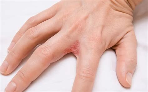 Dyshidrotic Eczema Causes Symptoms And Treatment