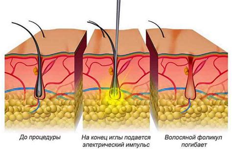Методы электроэпиляции и виды, показания для проведения