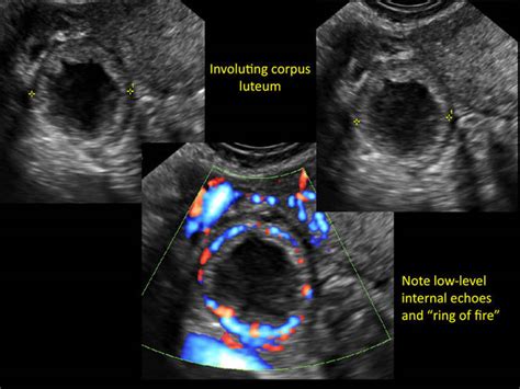 Hemorrhagic Ovarian Cysts One Entity With Many Appearances Mdedge Obgyn