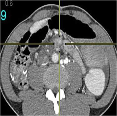 Paraganglioma