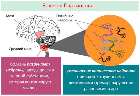 паркинсона болезнь что это такое симптомы простыми словами