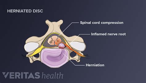 Cervical Herniated Disc Symptoms and Treatment Options | Spine-health