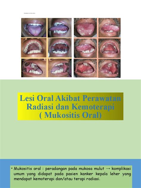 oral mukositis
