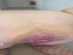 TEEN ASS FUCK WITH ZUCCHINI AND PROLAPSE ThisVid