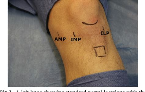 Figure 2 From All Inside Arthroscopic Meniscal Repair Technique Using A