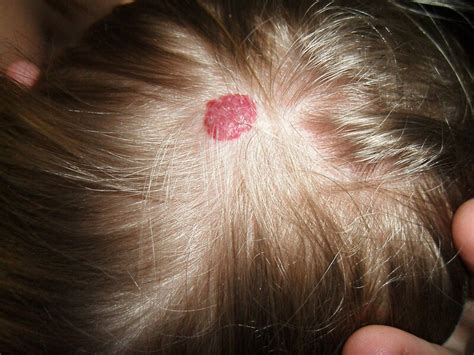 Hemangioma Wikipédia A Enciclopédia Livre