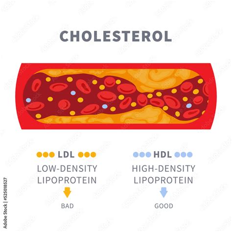 narrowed blood vessel  cholesterol plaque buildup artery blocked