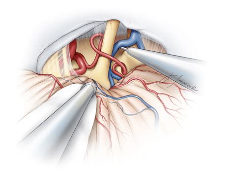 Geniculate Neuralgia | The Neurosurgical Atlas