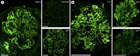 Renal Disease In Cryoglobulinemia Semantic Scholar