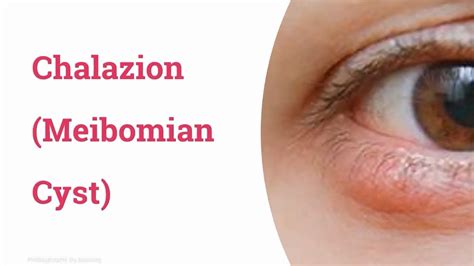 Chalazion Or Meibomian Cyst Youtube