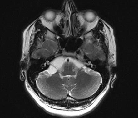 Arachnoid Cyst Cerebellopontine Angle Radiology Case Radiopaedia Org