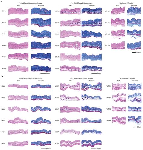 In Vivo Base Editing Rescues Hutchinson Gilford Progeria Syndrome In