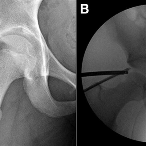 A Preoperative Right Hip Radiograph With Lateral Overhang And Download Scientific Diagram