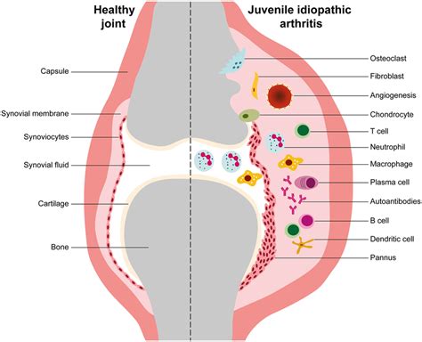 Synovial Inflammation In Juvenile Idiopathic Arthritis This Is A