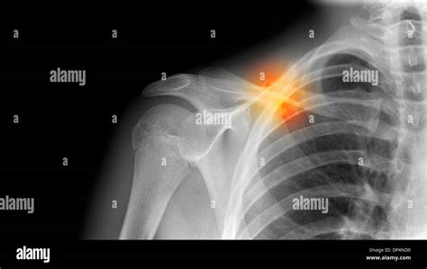 Clavicle Bone X Ray