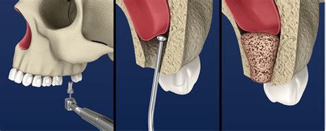 Sinus Lift And Dental Implant North Texas Dental Surgery