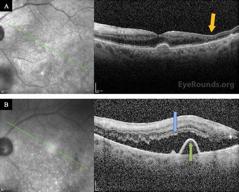 Eyerounds Org Bilateral Acute Retinal Necrosis