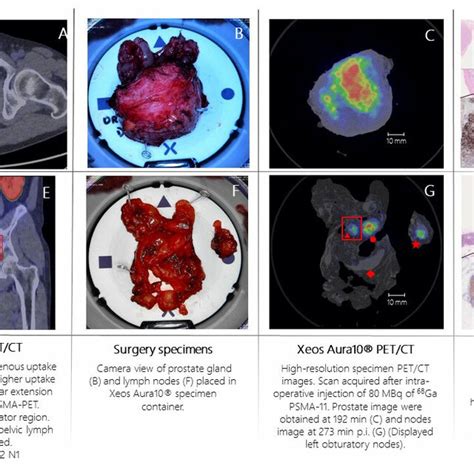 Patient 1 Prostate Cancer 68 Ga PSMA 11 Whole Body PET CT Image