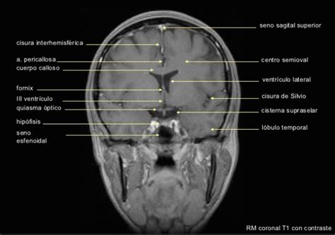 Resonancia Magnetica T Coronal Con Contraste Craneo Radiolog A
