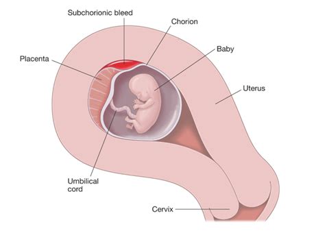 Subchorionic Hemorrhage | New Direction Fertility Centers