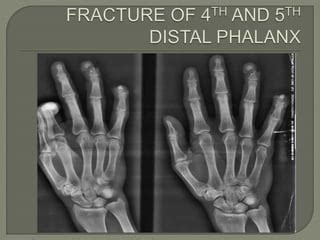 DIFFERENT TYPES OF FRACTURES IN HAND XRAY .pptx