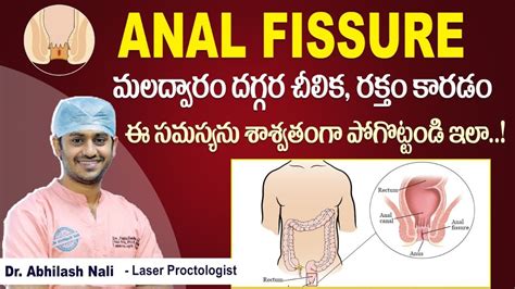ఫషర క శశవత చకతస Best Treatment for Anal Fissure Fissure Treatment Dr Abhilash